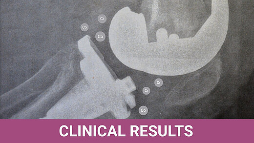 X‑ray image of a knee implant with labeled cobalt (Co) and chromium (Cr) markers indicating areas of metal‑ion release around the prosthetic components.