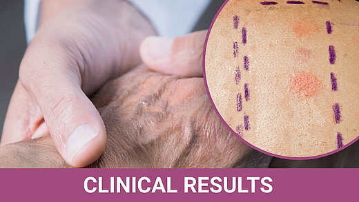 Image showing a clinical wrist examination with a magnified view of a PATCH test, illustrating the evaluation of possible metal hypersensitivity in cases of unexplained postoperative pain and swelling after hand surgery.