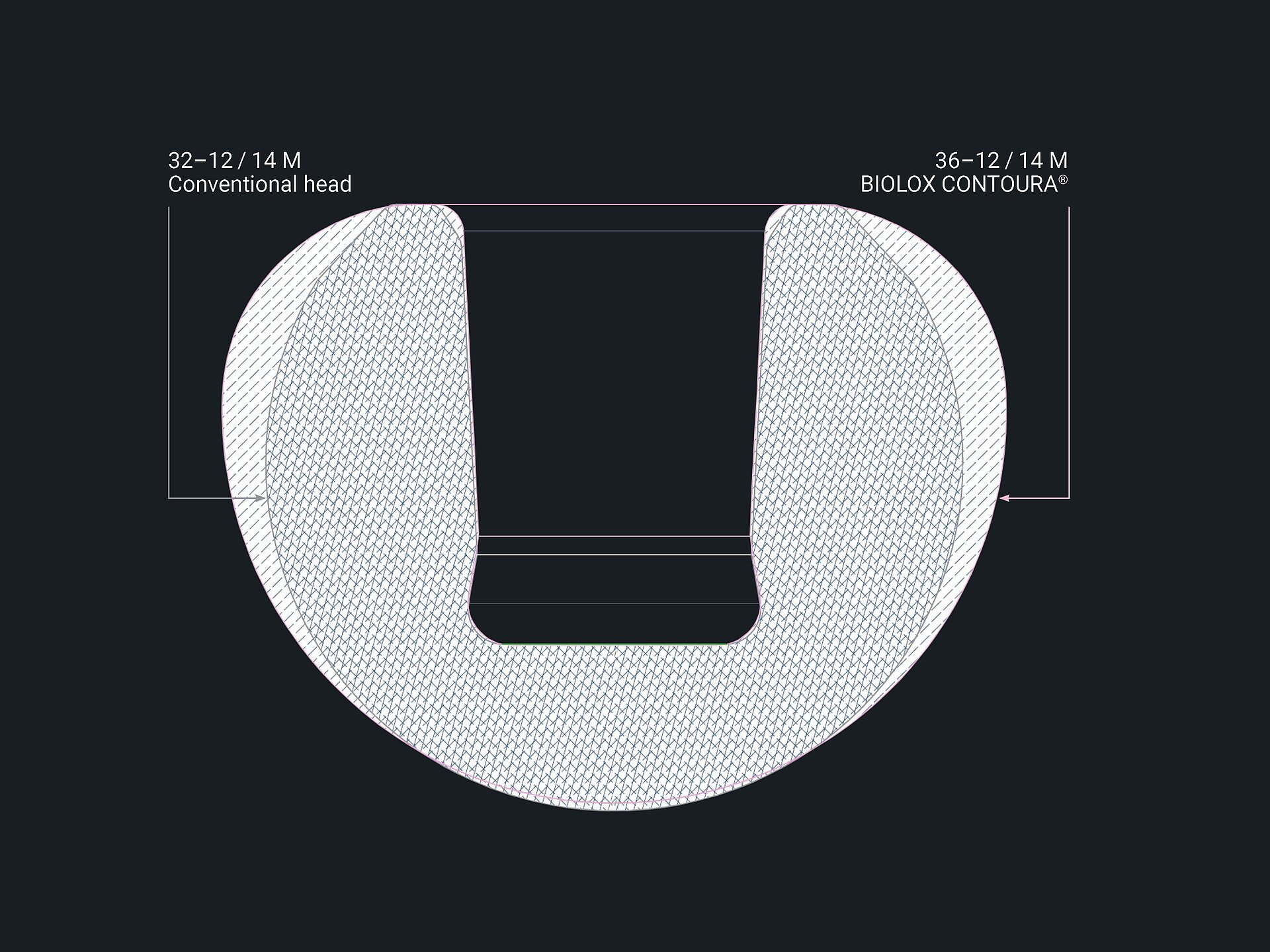 Technische Darstellung eines konturierten BIOLOX CONTOURA®-Hüftkopfes, mit Fokus auf den großen Durchmesser und das präzisionsgefertigte Design für orthopädische Implantate.