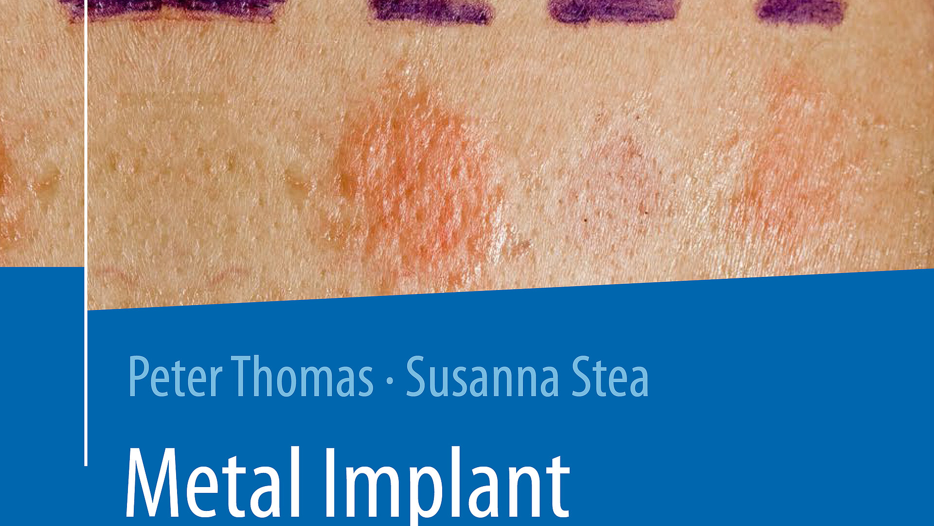 Book cover displaying dermatological skin reactions and the text “Peter Thomas · Susanna Stea – Metal Implant” on a blue background.
