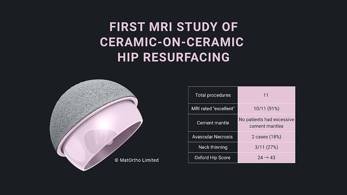 Infographic: first MRI study on ceramic-on-ceramic hip resurfacing with BIOLOX®delta implant and clinical outcome data.