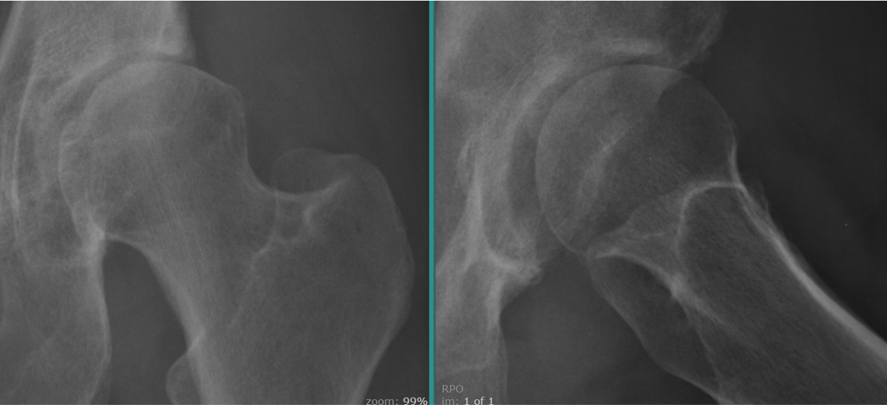 Imaging revealed a dysplastic hip with superior and anterior subluxation and joint space loss
