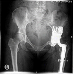Case 1: Revision of a Metal-on-Metal (MoM) hip by Prof_Alister_Hart. Figure 3: Anteroposterior plain radiograph taken at one year after the operation. No evidence of implant migration. Figure 3 Anteroposterior plain radiograph. CeraNews Issue 1 from 2024.